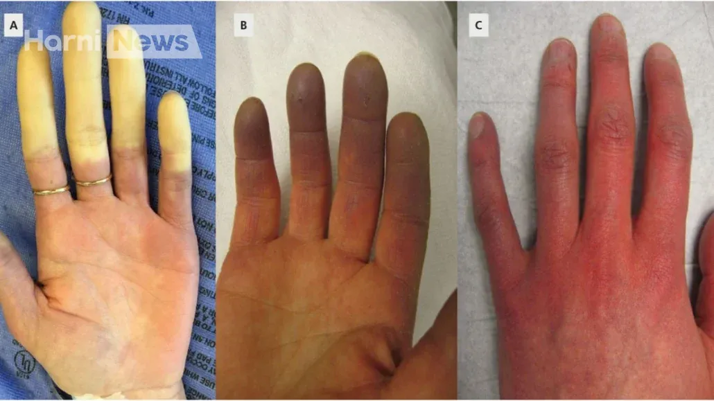 Як лікується синдром Рейно - фото
