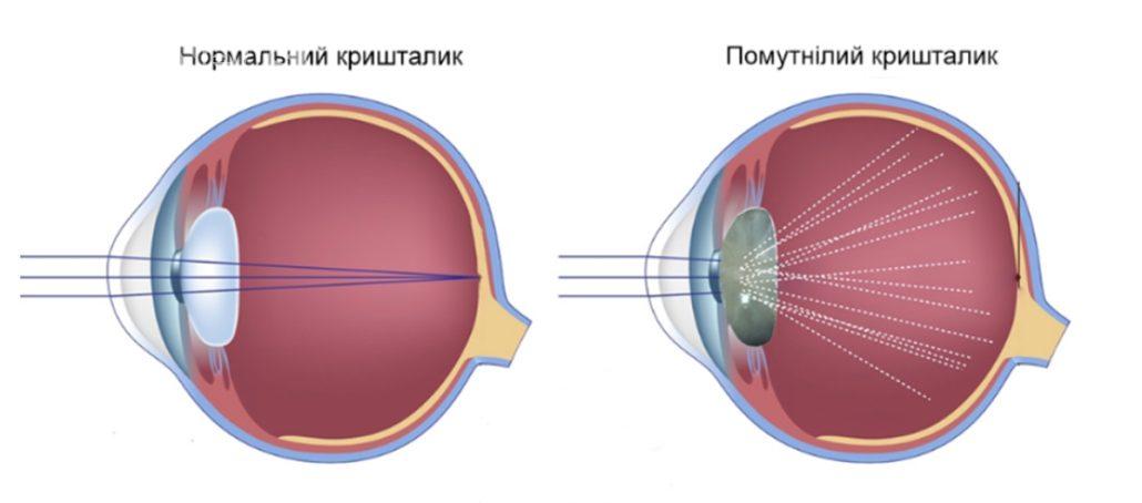 Лікування катаракти